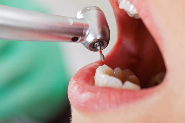 Best Root Canal Emergency Dentist  in Alderwood Manor, WA